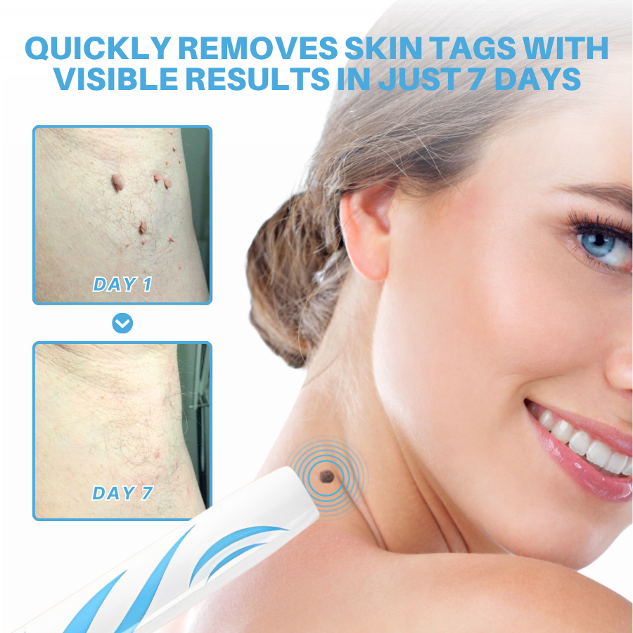Fivfivgo® Painless At-home Skin Tag Removal Pen 21 250710 Fivfivgo PainlessAt homeSkinTagRemovalPen Img4